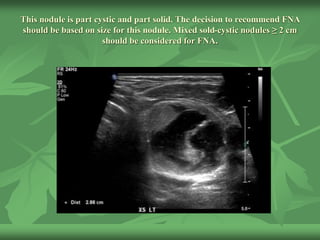 This nodule is part cystic and part solid. The decision to recommend FNA
should be based on size for this nodule. Mixed sold-cystic nodules ≥ 2 cm
should be considered for FNA.
 