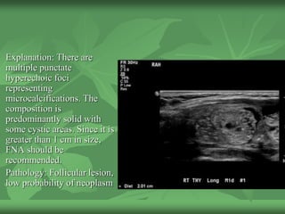 Explanation: There are
multiple punctate
hyperechoic foci
representing
microcalcifications. The
composition is
predominantly solid with
some cystic areas. Since it is
greater than 1 cm in size,
FNA should be
recommended.
Pathology: Follicular lesion,
low probability of neoplasm
 