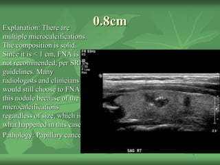 0.8cmExplanation: There are
multiple microcalcifications.
The composition is solid.
Since it is < 1 cm, FNA is
not recommended, per SRU
guidelines. Many
radiologists and clinicians
would still choose to FNA
this nodule because of the
microcalcifications
regardless of size, which is
what happened in this case.
Pathology: Papillary cancer!
 
