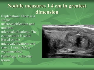 Nodule measures 1.4 cm in greatest
dimension
Explanation: There is a
single
macrocalcification and
multiple
microcalcifications. The
composition is solid.
Based on the
microcalcifications and
size ≥ 1 cm, FNA is
recommended.
Pathology: Follicular
lesion
 