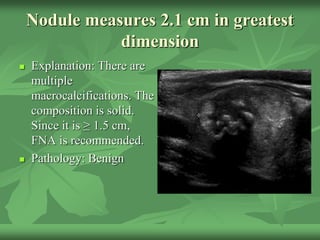 Nodule measures 2.1 cm in greatest
dimension
 Explanation: There are
multiple
macrocalcifications. The
composition is solid.
Since it is ≥ 1.5 cm,
FNA is recommended.
 Pathology: Benign
 
