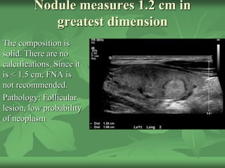 Nodule measures 1.2 cm in
greatest dimension
The composition is
solid. There are no
calcifications. Since it
is < 1.5 cm, FNA is
not recommended.
Pathology: Follicular
lesion, low probability
of neoplasm
 