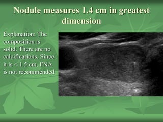 Nodule measures 1.4 cm in greatest
dimension
Explanation: The
composition is
solid. There are no
calcifications. Since
it is < 1.5 cm, FNA
is not recommended
 