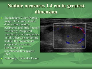 Nodule measures 1.4 cm in greatest
dimension
 Explanation: Color Doppler
image of the same nodule
demonstrates mainly
peripheral, and little internal
vascularity. Peripheral
vascularity is not suspicious.
In this otherwise borderline
nodule, the predominant
peripheral vascularity
strengthens the
recommendation against
FNA.
 Pathology: Follicular lesion
 