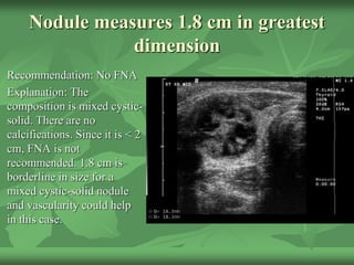 Nodule measures 1.8 cm in greatest
dimension
Recommendation: No FNA
Explanation: The
composition is mixed cystic-
solid. There are no
calcifications. Since it is < 2
cm, FNA is not
recommended. 1.8 cm is
borderline in size for a
mixed cystic-solid nodule
and vascularity could help
in this case.
 