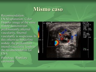 Mismo caso
Recommendation:
FNAExplanation: Color
Doppler image of the same
nodule demonstrates
predominantly internal
vascularity. Internal
vascularity is suspicious. In
this otherwise borderline
nodule, the predominant
intenal vascularity leads to
the recommendation for
FNA.
Pathology: Papillary
carcinoma
 