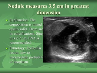 Nodule measures 3.5 cm in greatest
dimension
 Explanation: The
composition is mixed
cystic-solid. There are
no calcifications. Since
it is ≥ 2 cm, FNA is
recommended.
 Pathology: Follicular
lesion, low to
intermediate probability
of neoplasm
 