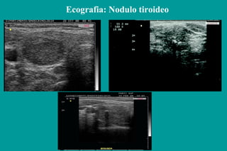 Ecografia: Nodulo tiroideo
 