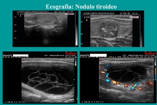 Ecografia: Nodulo tiroideo
 