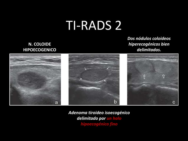 Nódulo tiroideo ti rads eco baaf | PPSX