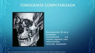 TOMOGRAFÍA COMPUTARIZADA
Reconstrucción 3D de la
tomografía
computarizada que
muestra segmento naso-
orbito-etmoides
fract...