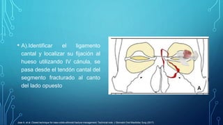 • A).Identificar el ligamento
cantal y localizar su fijación al
hueso utilizando IV cánula, se
pasa desde el tendón cantal...