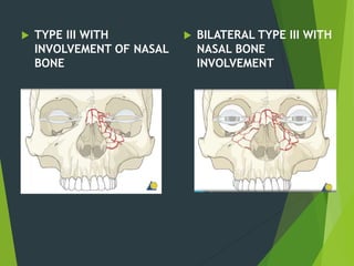 TYPE III WITH
INVOLVEMENT OF NASAL
BONE
 BILATERAL TYPE III WITH
NASAL BONE
INVOLVEMENT
 