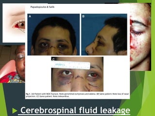  Cerebrospinal fluid leakage
• Subconjuctival
haemorrhage.
• Traumatic
telecanthus
• Circumorbital
oedema and
ecchymosis
• Epistaxis
 