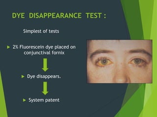DYE DISAPPEARANCE TEST :
Simplest of tests
 2% Fluorescein dye placed on
conjunctival fornix
 Dye disappears.
 System patent
 