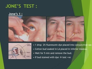 JONE’S TEST :
Jone’s 1 :
• 1 drop 2% fluorescein dye placed into conjunctival sac.
• Cotton bud soaked in LA placed in inferior meatus.
• Wait for 5 min and remove the bud.
• If bud stained with dye  test +ve
 