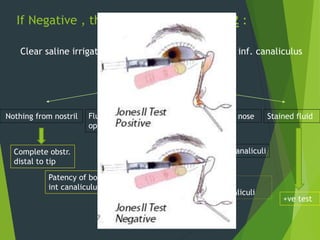 If Negative , then proceed to JONE’S 2 :
Clear saline irrigated through cannula inserted into inf. canaliculus
Patient bends forward
Nothing from nostril
Complete obstr.
distal to tip
Fluid regurgutates –
opp. punctum
Patency of both canaliculi till
int canaliculus
Clear fluid from nose
Dye not entered canaliculi
Blocked
punctum/canaliculi
Stained fluid
+ve test
 
