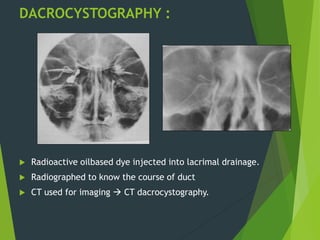 DACROCYSTOGRAPHY :
 Radioactive oilbased dye injected into lacrimal drainage.
 Radiographed to know the course of duct
 CT used for imaging  CT dacrocystography.
 