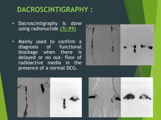 DACROSCINTIGRAPHY :
• Dacroscintigraphy is done
using radionuclide (Tc-99)
• Mainly used to confirm a
diagnosis of functional
blockage when there is
delayed or no out- flow of
radioactive media in the
presence of a normal DCG.
 