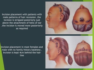 Incision placement with patients with
male patterns of hair recession .the
incision is stripped posteriorly just
above the attachment of helix of ear
.the incision is moved more posteriorly
as required
Incision placement in most females and
male with no family history baldness .
Incision is kept 4cm behind the hair
line
 