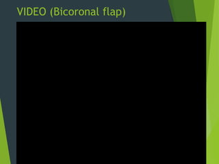 VIDEO (Bicoronal flap)
 