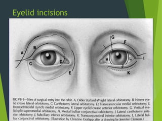 Eyelid incisions
D - Transcaruncular approach
E - Lynch approach
 