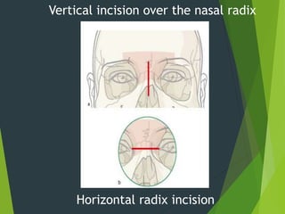 Vertical incision over the nasal radix
Horizontal radix incision
 