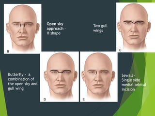 Open sky
approach –
H shape
Two gull
wings
Butterfly - a
combination of
the open sky and
gull wing
Sewall -
Single side
medial orbital
incision
 