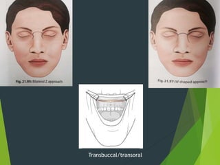 Transbuccal/transoral
 