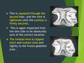  This is repeated through the
second hole, and the wire is
tightened until the canthus is
firmly secured.
 This is again inspected from
the skin side to be absolutely
sure of the correct location.
 The twisted wire is clipped
short and tucked close and
tightly to the fronto-glabellar
area .
 
