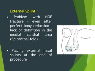 External Splint :
• Problem with NOE
fracture – even after
perfect bony reduction –
lack of definition in the
medial canthal area
(Epicanthal fold)
• Placing external nasal
splints at the end of
procedure
 