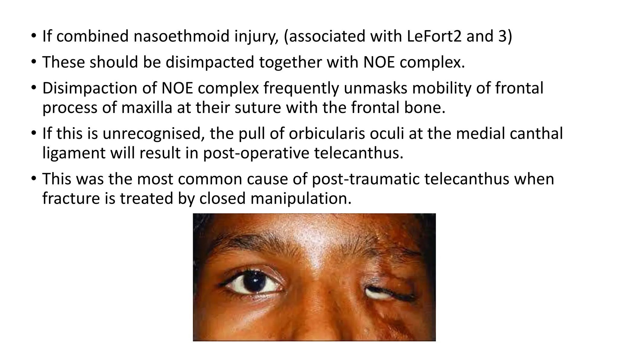 • If combined nasoethmoid injury, (associated with LeFort2 and 3)
• These should be disimpacted together with NOE complex.
• Disimpaction of NOE complex frequently unmasks mobility of frontal
process of maxilla at their suture with the frontal bone.
• If this is unrecognised, the pull of orbicularis oculi at the medial canthal
ligament will result in post-operative telecanthus.
• This was the most common cause of post-traumatic telecanthus when
fracture is treated by closed manipulation.
 
