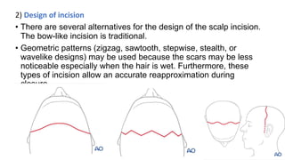 Anchor Incision Pattern NOE fracture.pptx