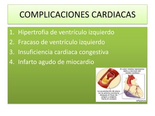 COMPLICACIONES CARDIACAS
1. Hipertrofia de ventrículo izquierdo
2. Fracaso de ventrículo izquierdo
3. Insuficiencia cardiaca congestiva
4. Infarto agudo de miocardio
 