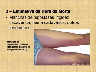 3 – Estimativa da Hora da Morte
• Manchas de hipóstases, rigidez
cadavérica, fauna cadavérica, outros
fenômenos.
Manchas de
hipóstases cutâneas
(congestão passiva de
sangue acumulado)
 