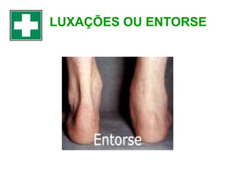 LUXAÇÕES OU ENTORSE

 