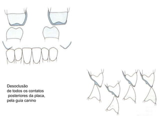 Desoclusão de todos os contatos posteriores da placa, pela guia canino