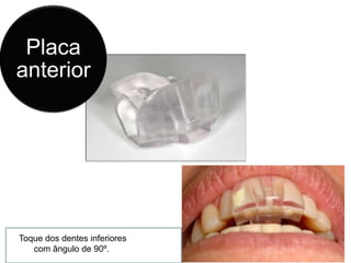 que permitiu o toque dos dentes inferiores com ângulo de 90º.  Toque dos dentes inferiores com ângulo de 90º. 