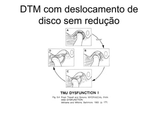 DTM com deslocamento de disco sem redução 