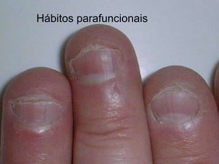 Hábitos parafuncionais