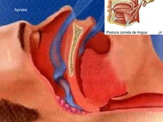 ApnéiaPostura correta de língua 