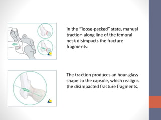 neck of femur fracture | PPTX
