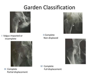 Garden Classification
I Valgus impacted or
incomplete
II Complete
Non-displaced
III Complete
Partial displacement
IV Complete
Full displacement
 