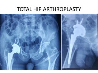 TOTAL HIP ARTHROPLASTY
 