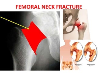 FEMORAL NECK FRACTURE
 