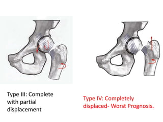 Type III: Complete
with partial
displacement
Type IV: Completely
displaced- Worst Prognosis.
 