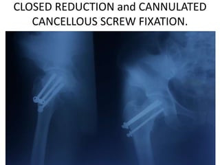 CLOSED REDUCTION and CANNULATED
CANCELLOUS SCREW FIXATION.
 