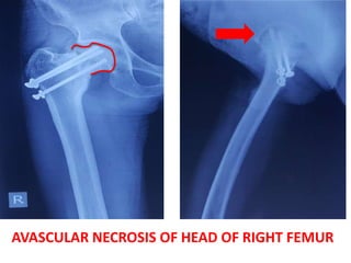AVASCULAR NECROSIS OF HEAD OF RIGHT FEMUR
 
