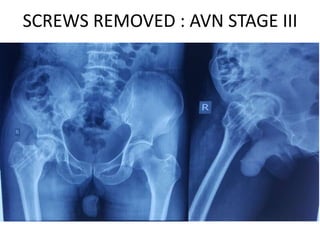SCREWS REMOVED : AVN STAGE III
 