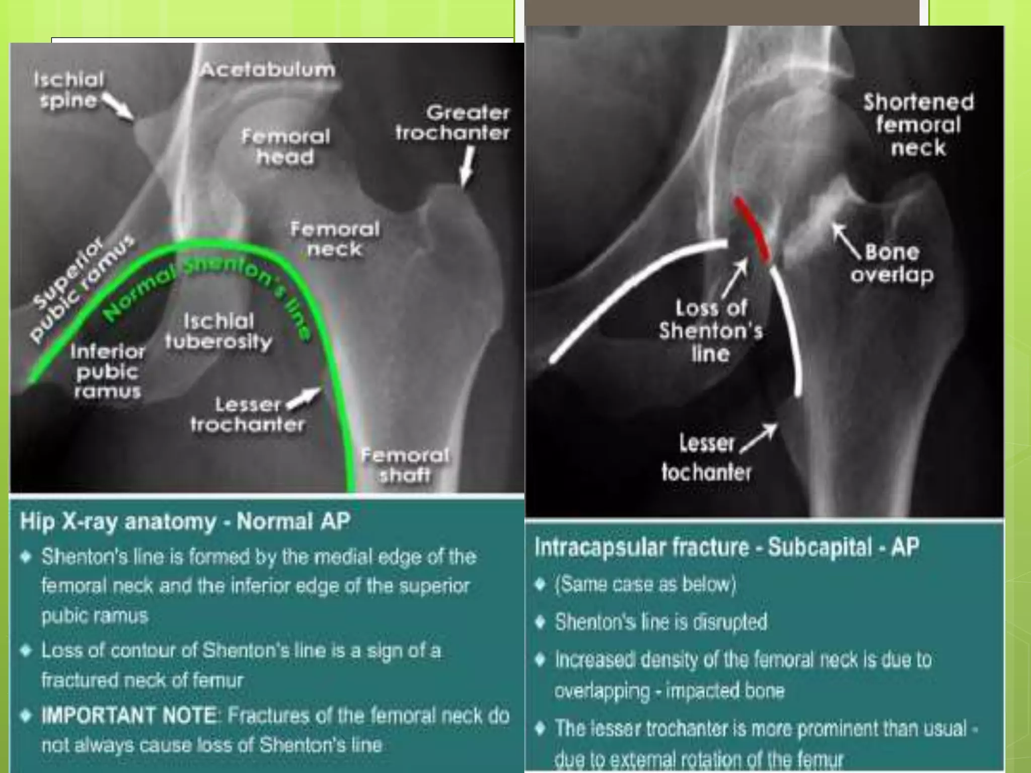 Nof Fracture PPTX
